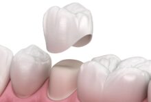 روکش دندان با بیمه (کدام بیمه هزینه روکش دندان را پوشش می دهد؟) روکش دندان با بیمه (کدام بیمه هزینه روکش دندان را پوشش می دهد؟)